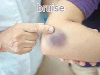 Định nghĩa & cách phát âm từ bruise