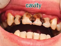 Định nghĩa & cách phát âm từ cavity