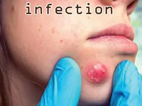 Định nghĩa & cách phát âm từ infection